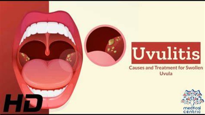 Why do I keep getting uvulitis?